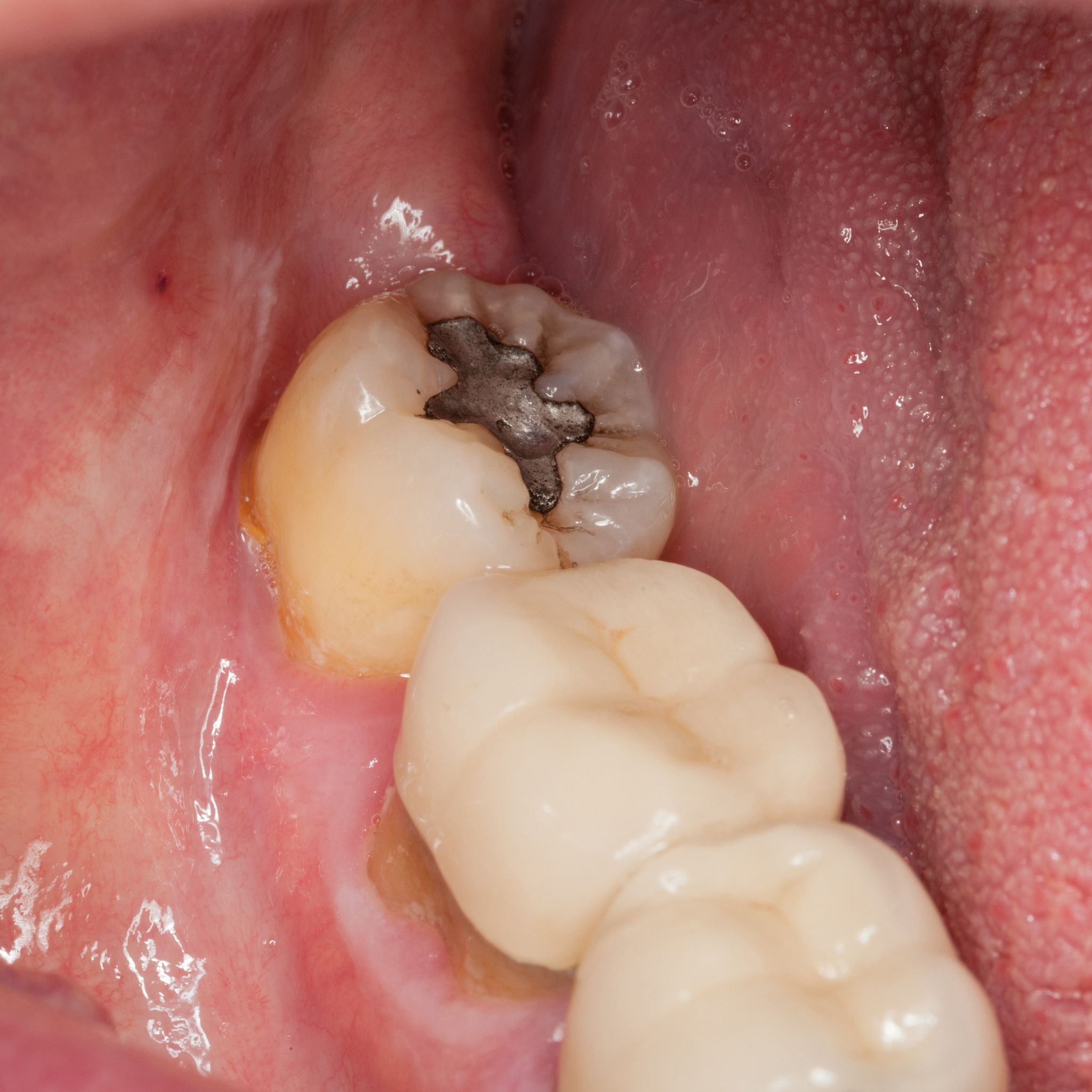 Close up of back molar that has dark decay