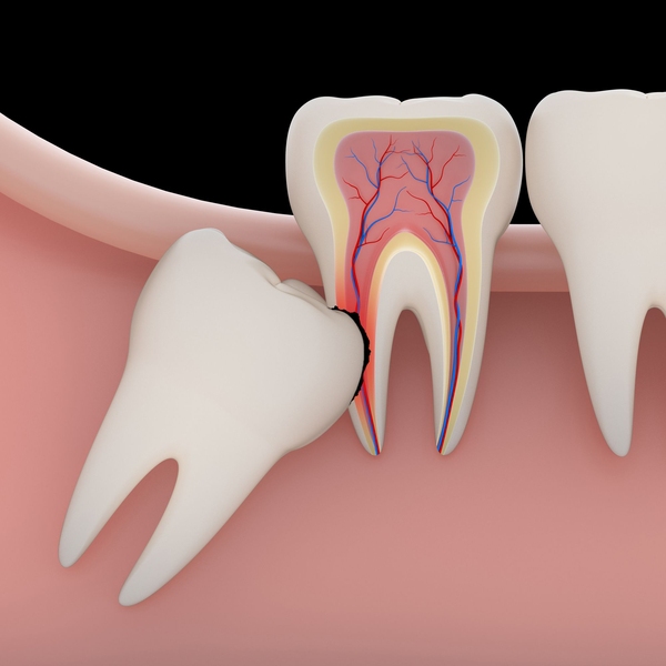 impacted tooth