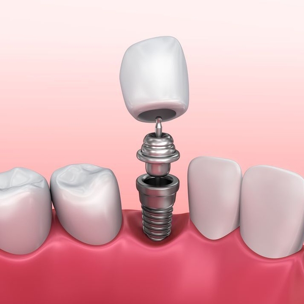 dental implant