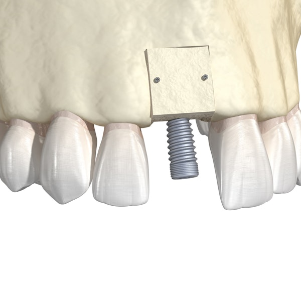 bone graft and implant