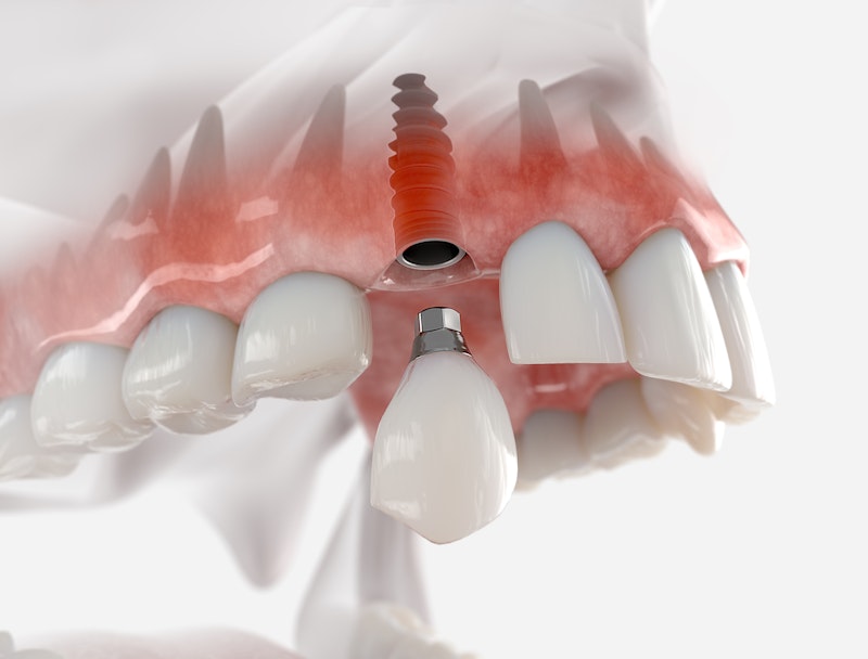 Digital rending of dental implant in jaw
