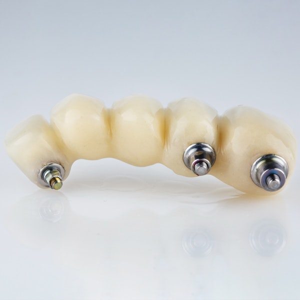 Dental implant bridge