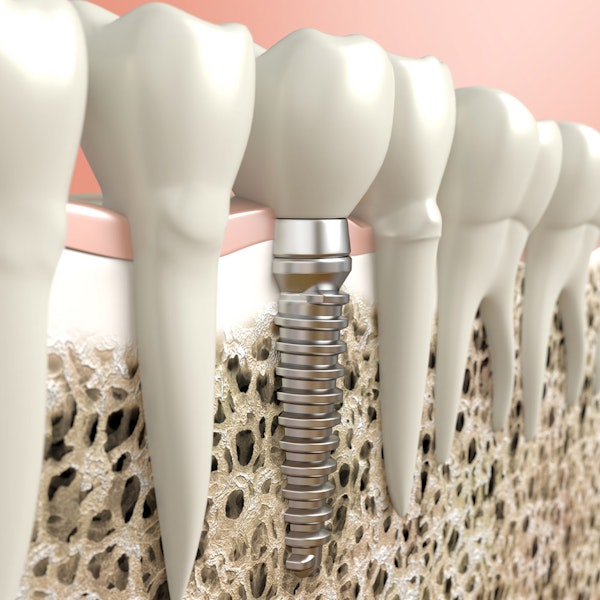 Dental Implant Illustration