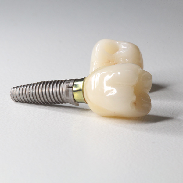 Two dental implants
