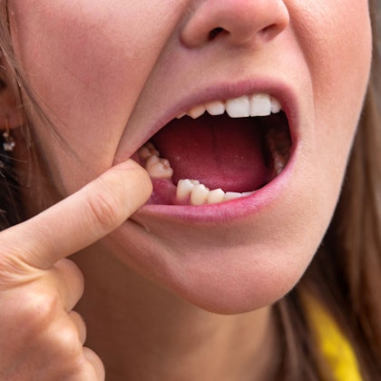 Close up of woman's mouth missing a molar