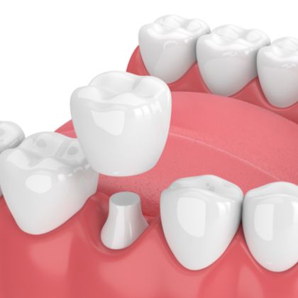 Dental crown placed onto tooth after root canal