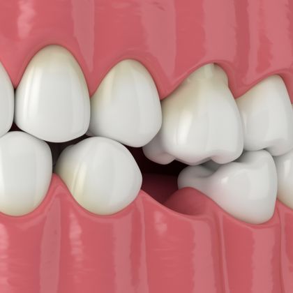 Missing tooth