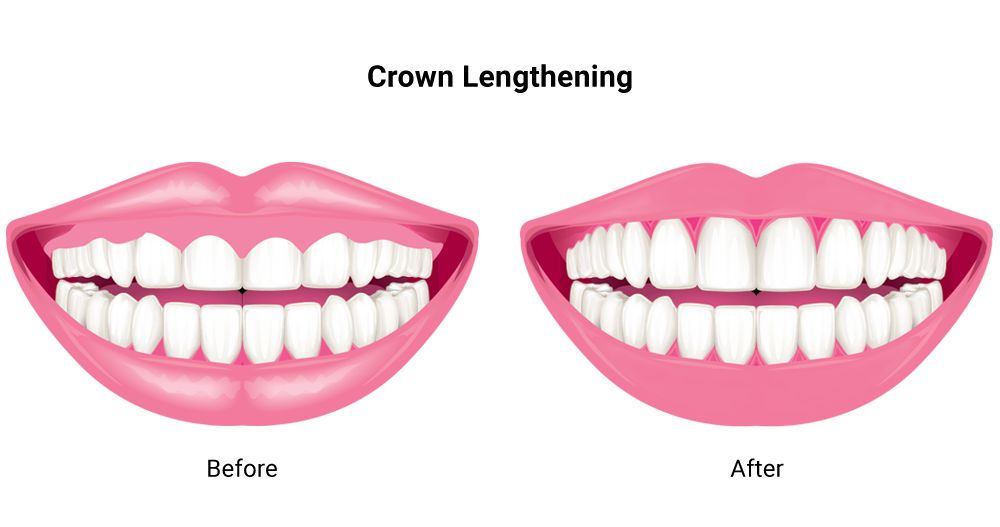 A graphic showing a before and after illustration of crown lengthening.
