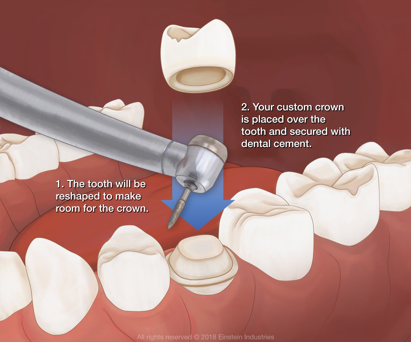 The tooth will be reshaped to make room for the custom crown to be placed over and then secured with dental cement.
