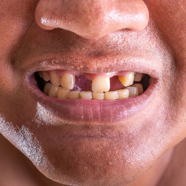 Man's mouth missing several teeth
