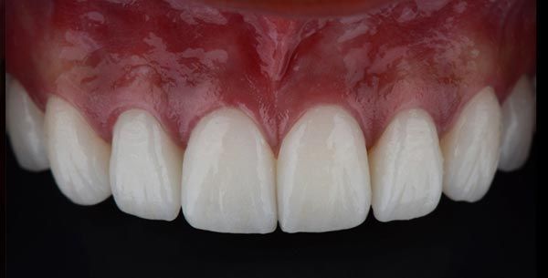 After treatment