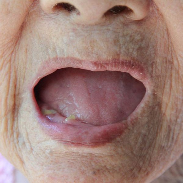 Woman's mouth with no teeth