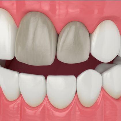 Stained teeth