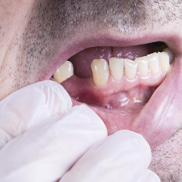 Man's mouth and missing tooth