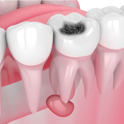 Tooth with severe decay