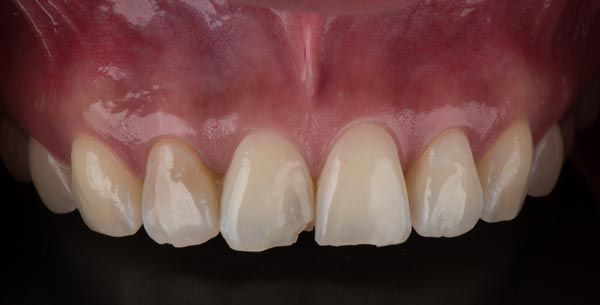 Before treatment