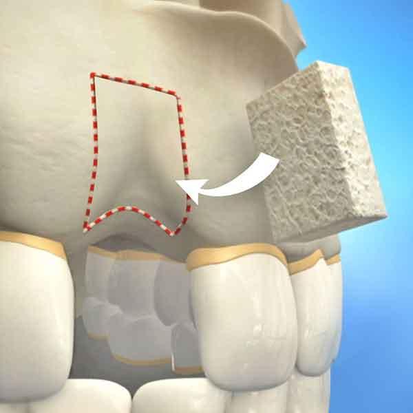 bone grafting