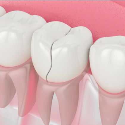 Cracked tooth