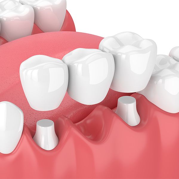 Dental bridge