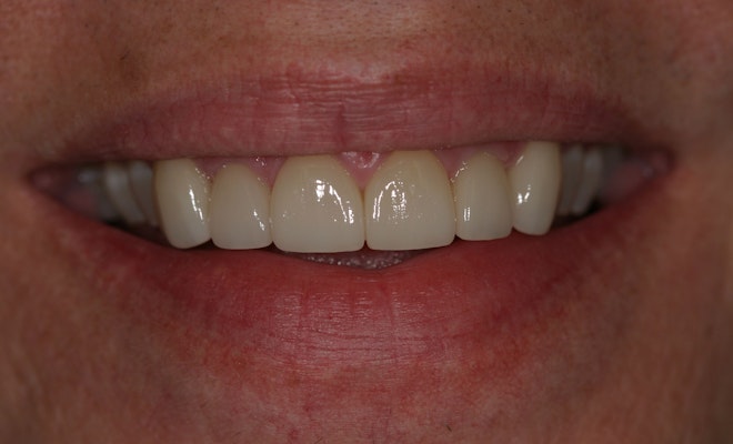 Teeth after treatment that are perfectly straight