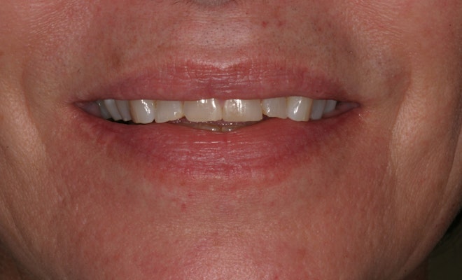 Teeth before treatment that are crooked