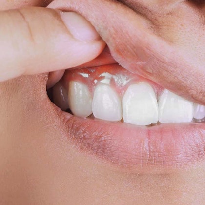 Gums that have gum disease evident on them