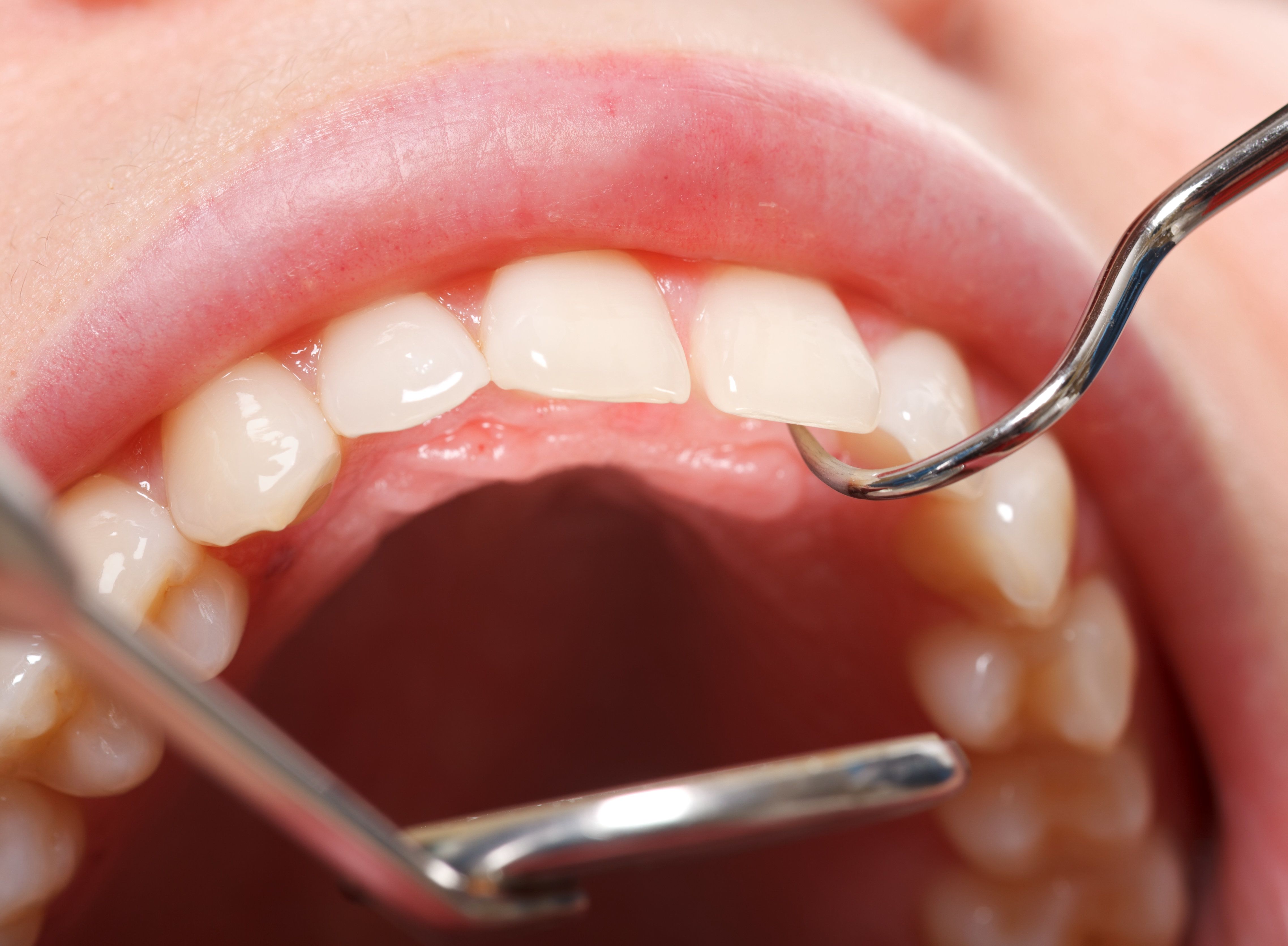 dental cleaning