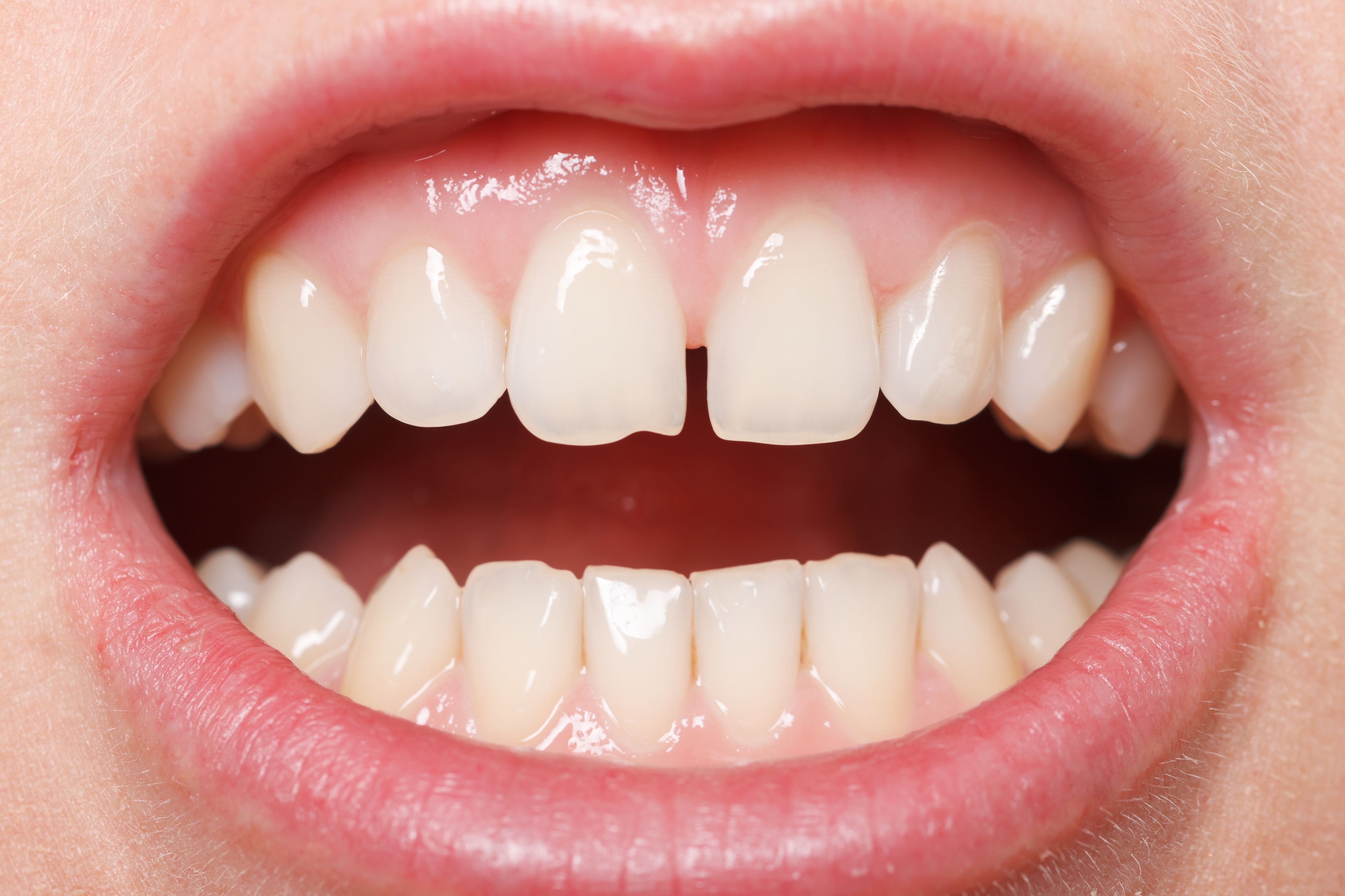 chipped tooth
