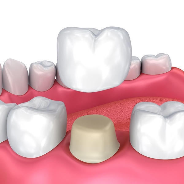 dental crowns