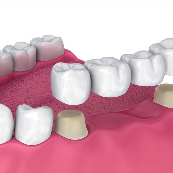 dental bridge