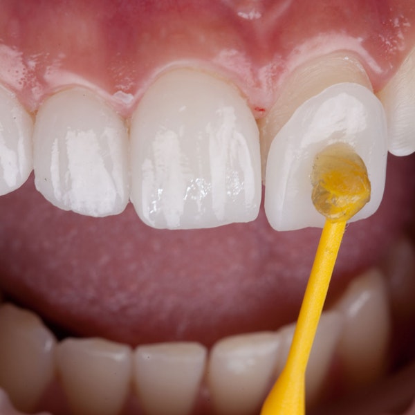 Veneer being applied to tooth