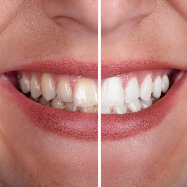 Before and after teeth whitening