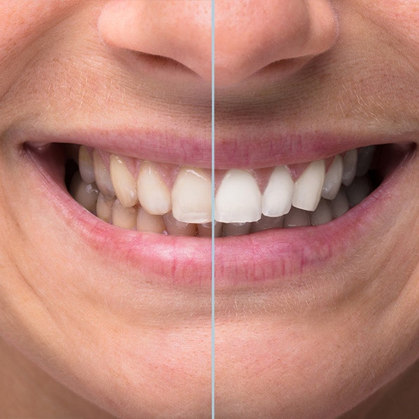 On the left are stained teeth, on the right are the same teeth but white