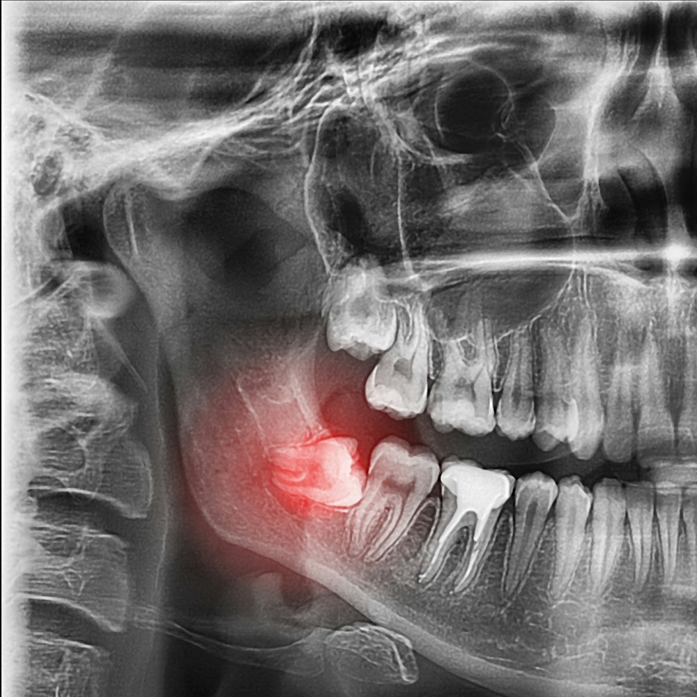 Wisdom teeth impaction x-ray